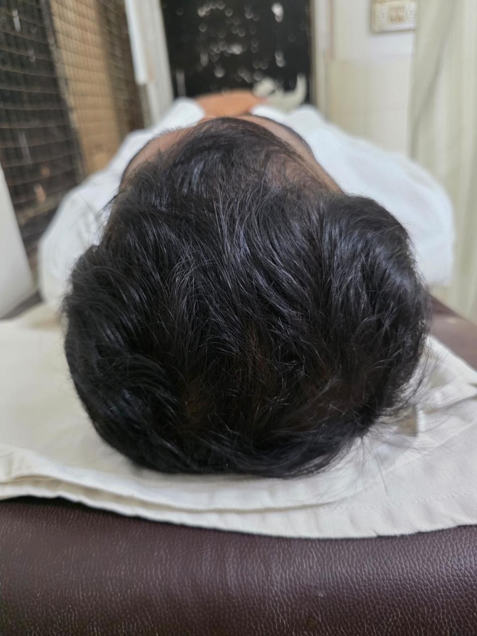 Hair Density Restoration — after treatment