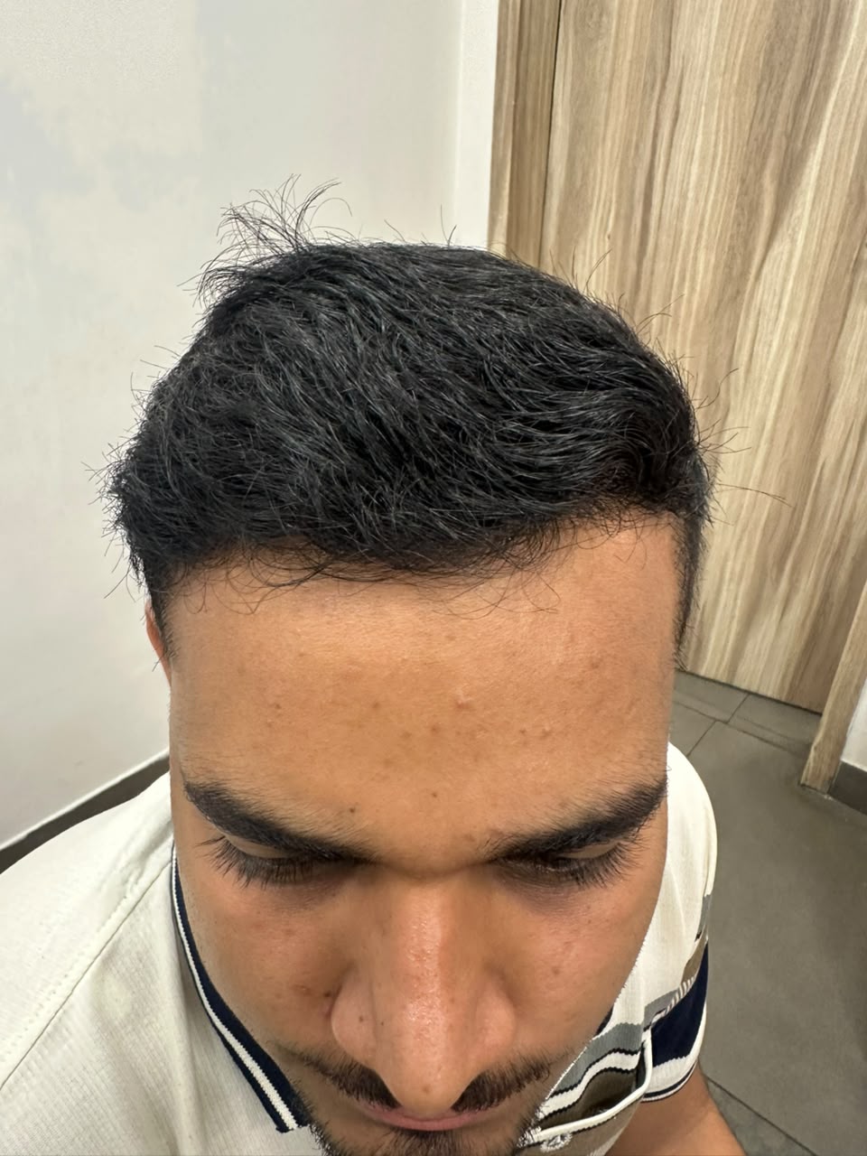 Hairline Refinement — after treatment