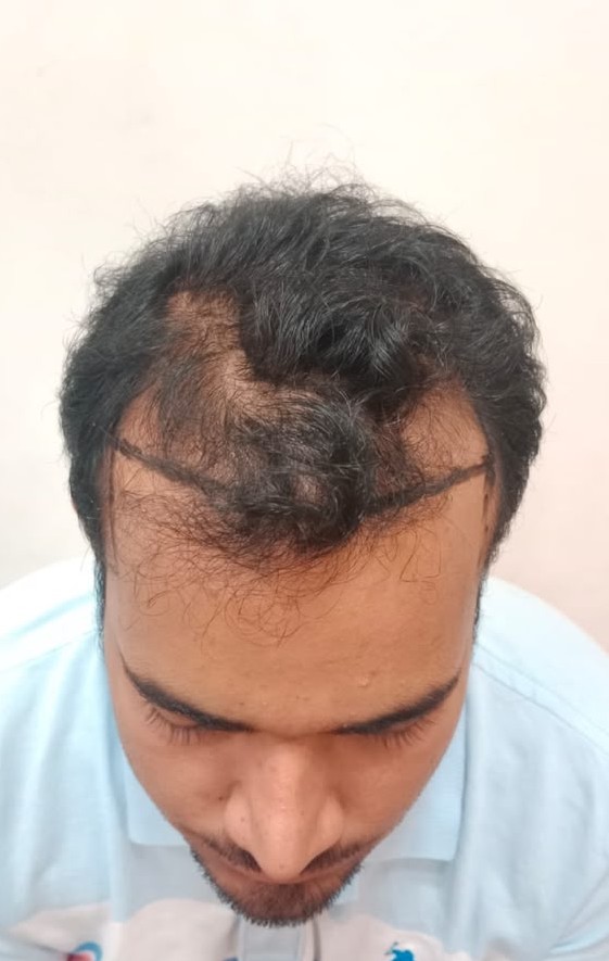 Hairline Refinement — before treatment